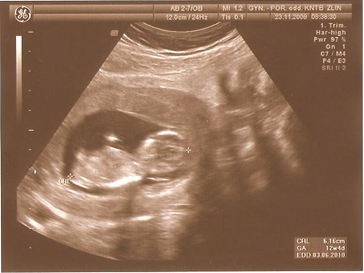 03-12+4tt CRL 6,16cm NT Screening