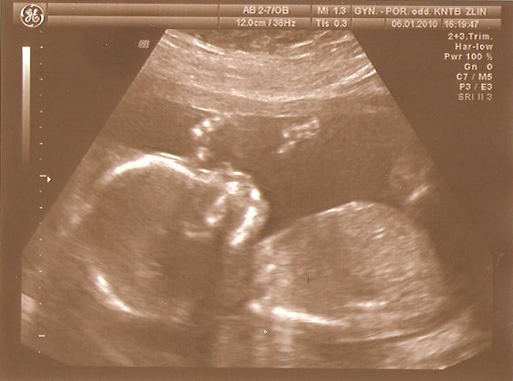 09-18+4tt, NT screening II.trimestru